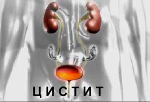 Цистит 